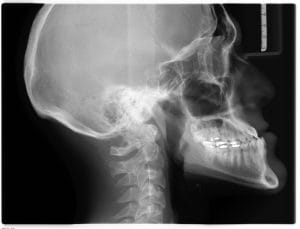 Kjevesmerter/ osteopat / Drammen Kjevesmerter/ osteopat / Drammen